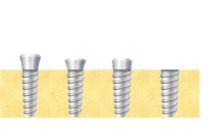 custom-titanium-dental-implant