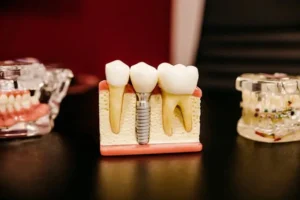 titanium-tooth-implant