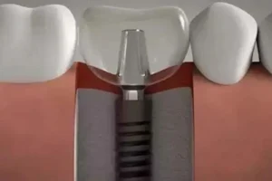 titanium-tooth-implant-price