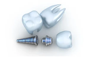 titanium-tooth-implant-stock