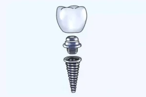 titanium-tooth-implant-stock-for-sale